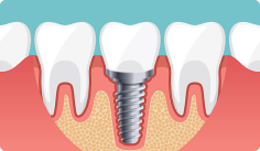 Single Tooth Implant